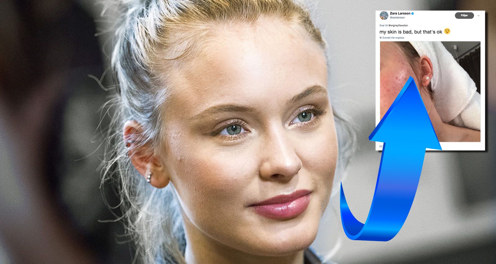Fit Crop 854 Zara Larsson Om Sin Acne Det Ar Okej Aftonbladet Fit Crop 854 Zara Larsson Om Sin Acne Det Ar Okej Aftonbladet